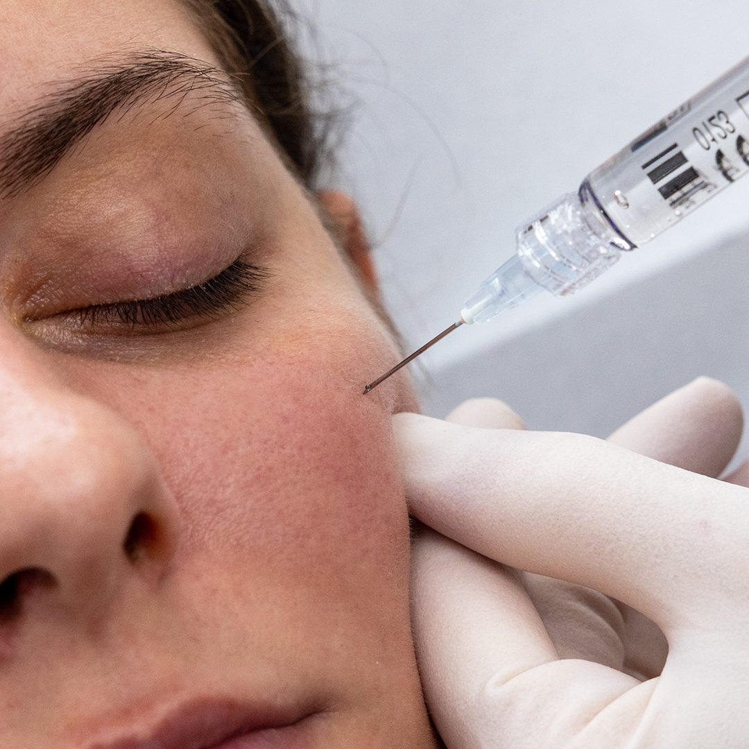 Acidehyaluronique-comblement