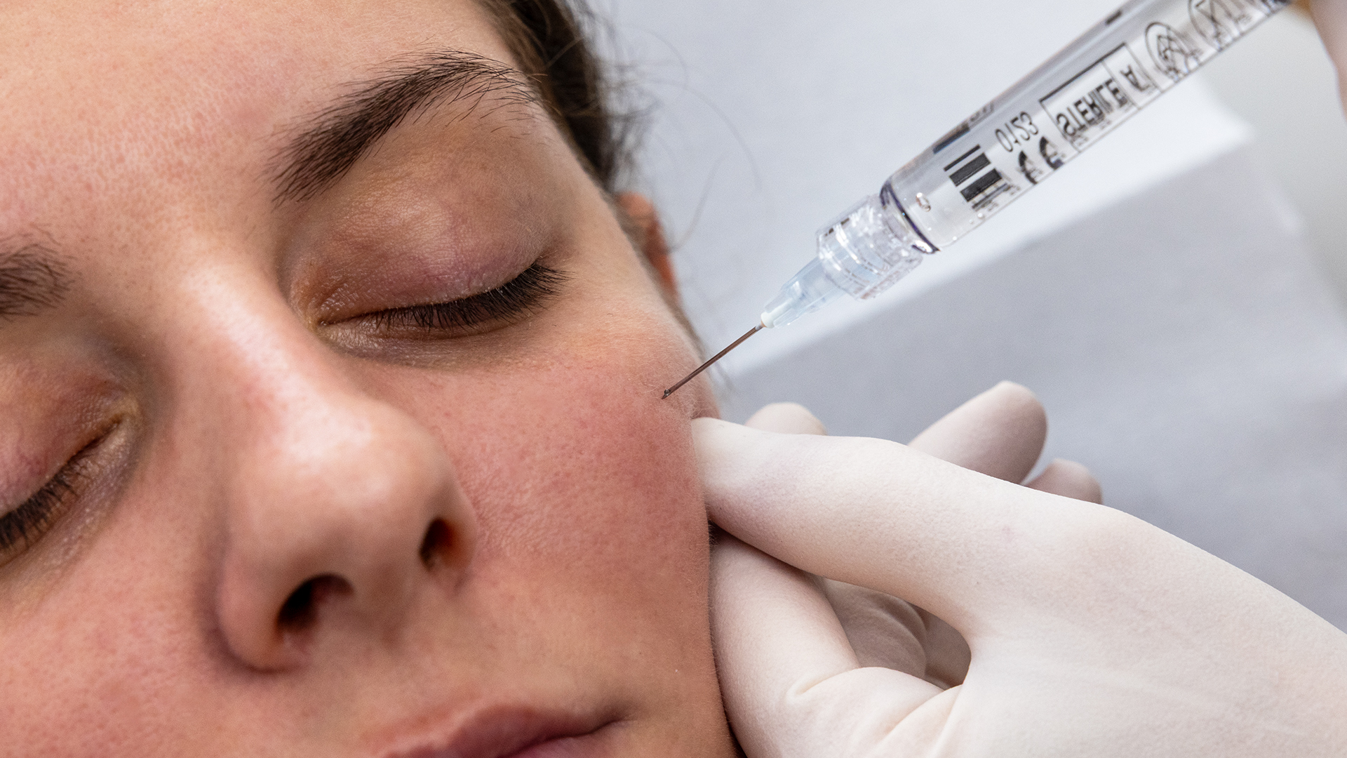 Acidehyaluronique-comblement